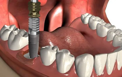 Возможные осложнения после имплантации зубов