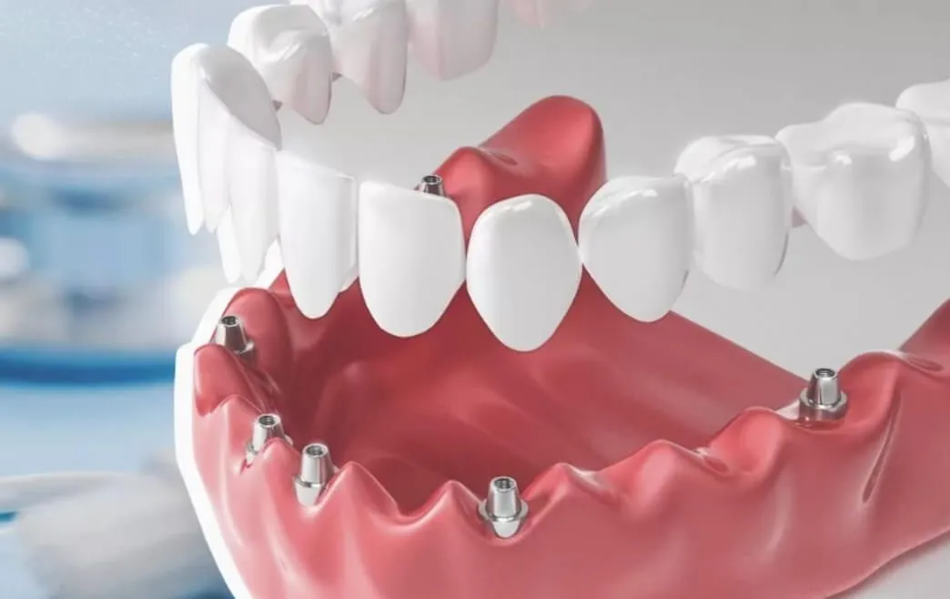 Протезирование на имплантах при полном отсутствии зубов