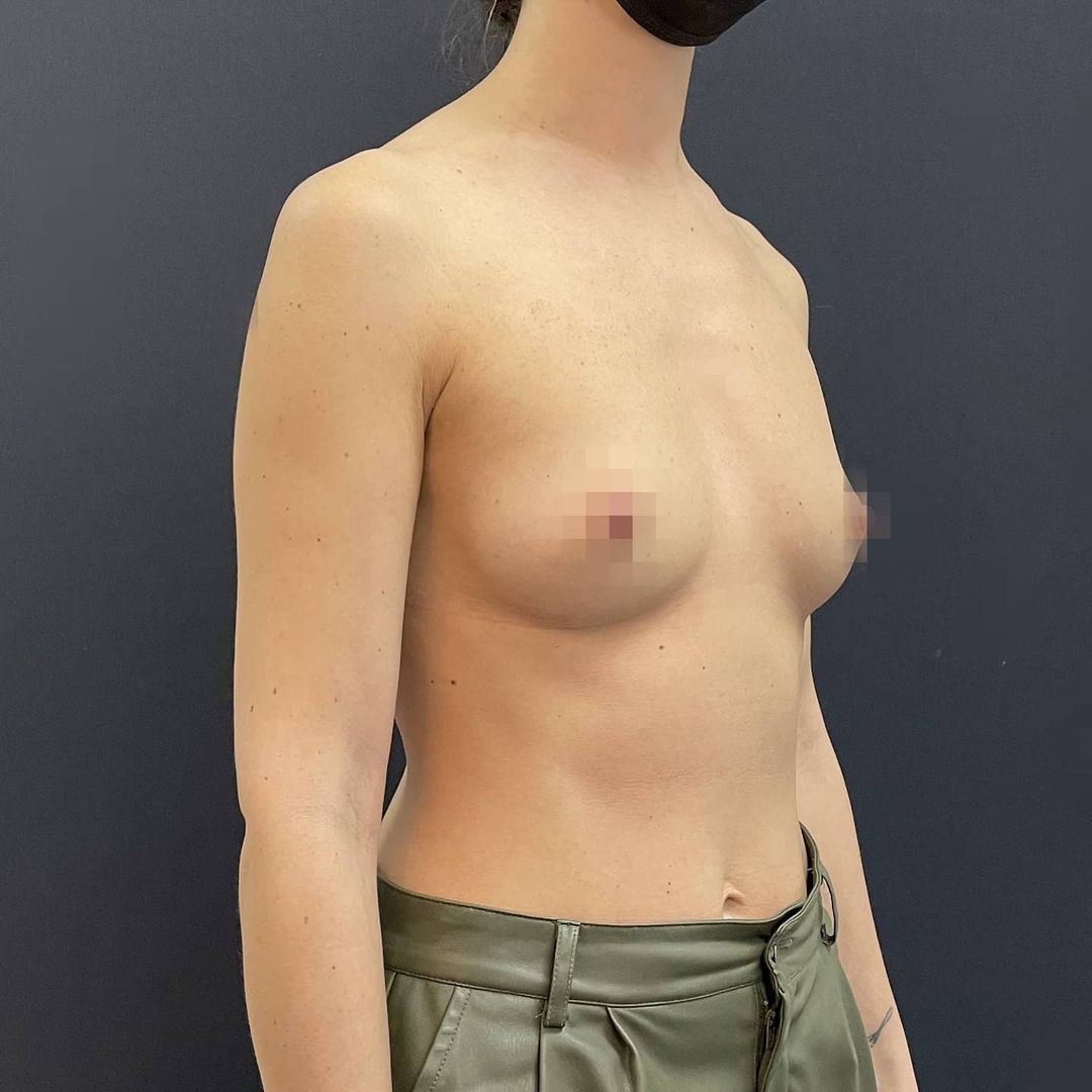 одна грудь увеличилась после родов фото 92